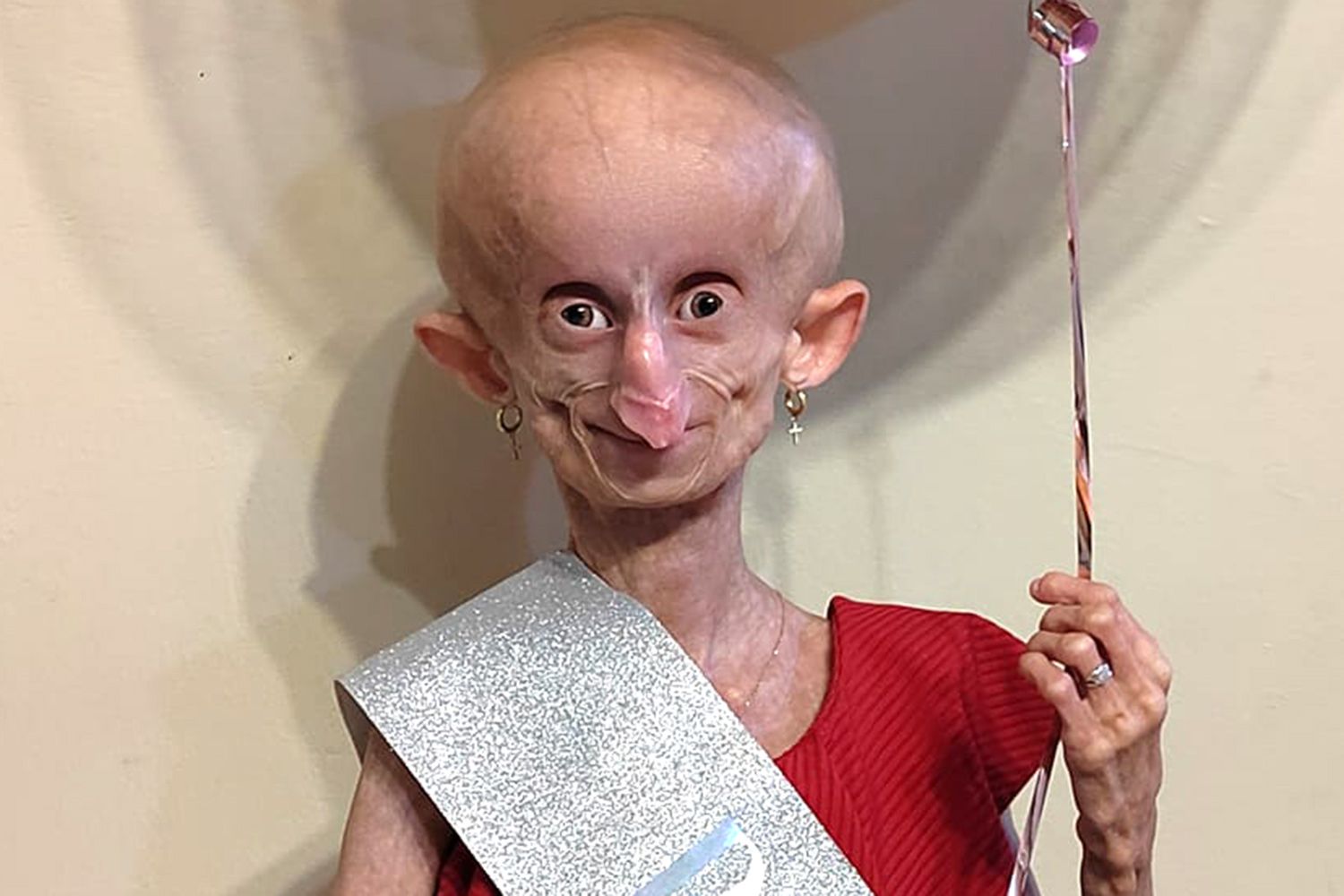 Beandri Booysen, influenciadora com doença rara, morre aos 19 anos; VEJA VÍDEO