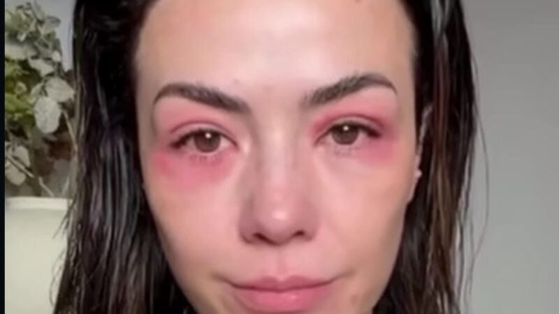 Influencer suspende maquiagem após crise alérgica no rosto e preocupa seguidores; Veja vídeo