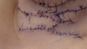 Agressão do companheiro deixa mulher com mais de 100 pontos no pescoço e extensas lesões pelo corpo; veja vídeo