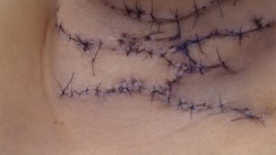 Agressão do companheiro deixa mulher com mais de 100 pontos no pescoço e extensas lesões pelo corpo; veja vídeo