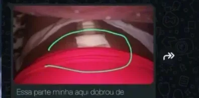 “Não é psicológico”: brasileira deixa vídeo desesperador antes de morrer após cirurgia estética; Veja Vídeo