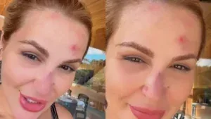 VÍDEO: Deolane surge machucada após acidente doméstico e assusta seguidores